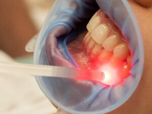 laserterapia